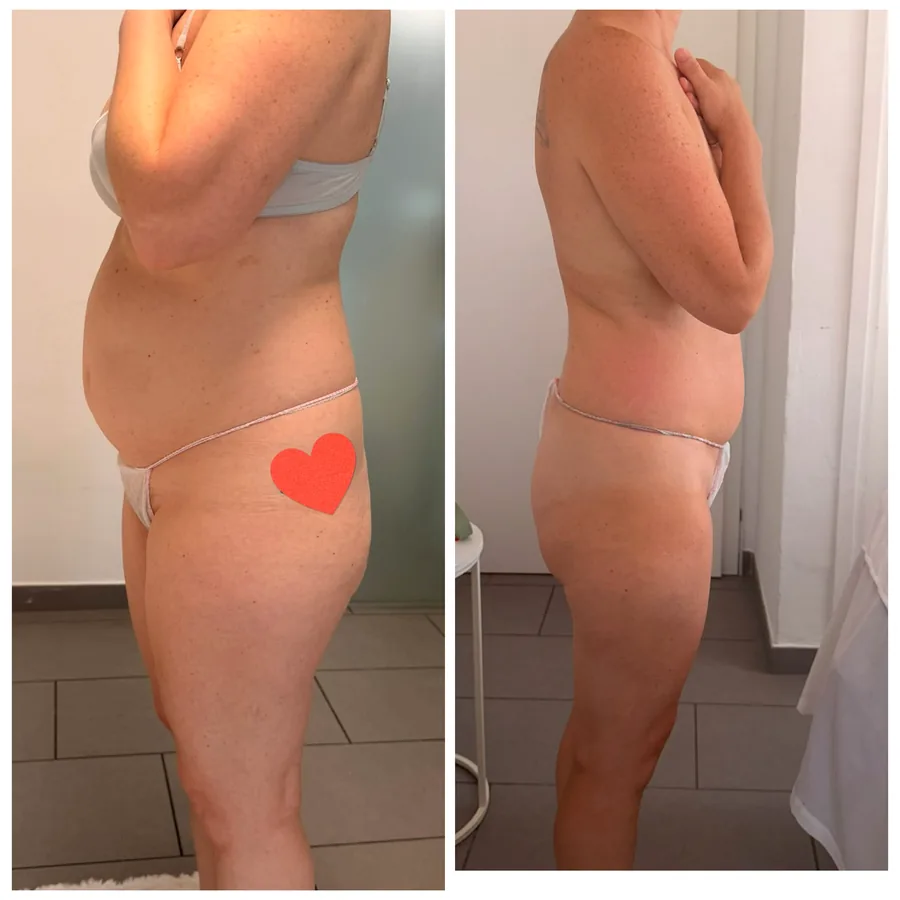 Prima e dopo i nostri percorsi corpo: Trattamenti anticellulite personalizzati — Estetica Beauty & Care