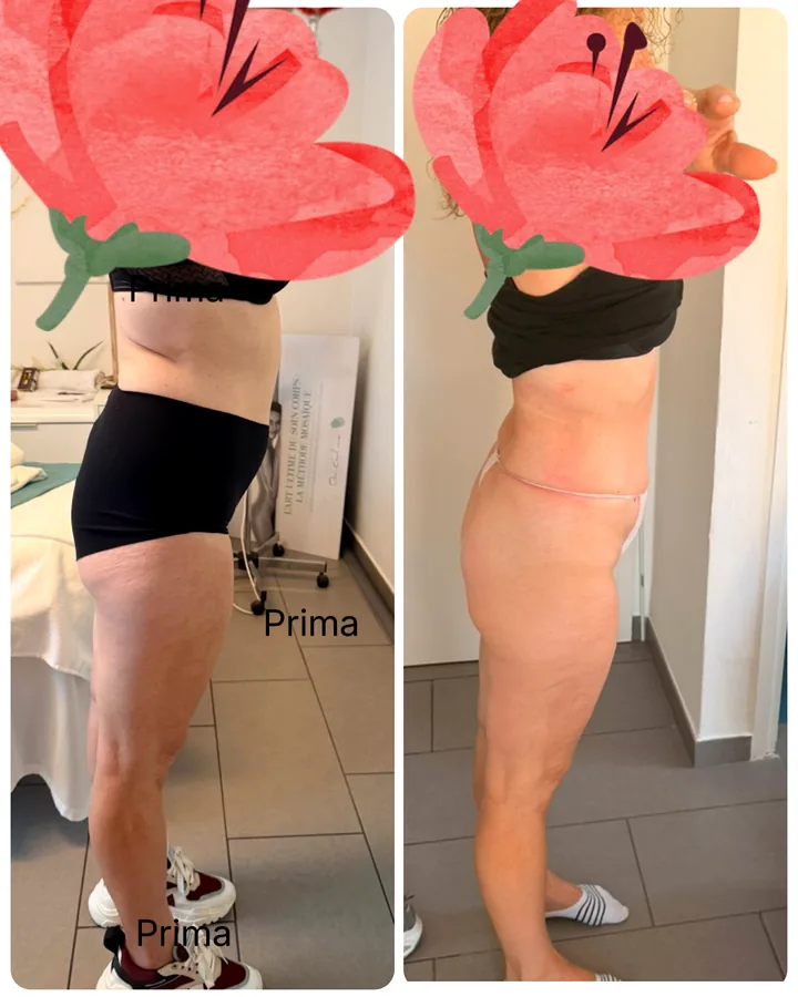 Prima e dopo i nostri percorsi corpo: Cavitazione a ultrasuoni — Estetica Beauty & Care