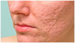 Estetica beauty_and_care losone ACNE RESIDUA 2025