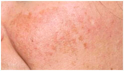 Estetica beauty_and_care losone MELASMA 2025